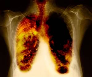 Lung_cancer.jpg