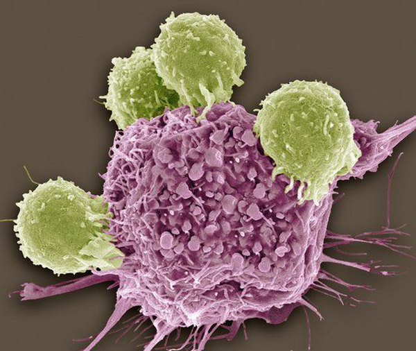 c0011679-t_lymphocytes_and_cancer_cell_sem-spl.png