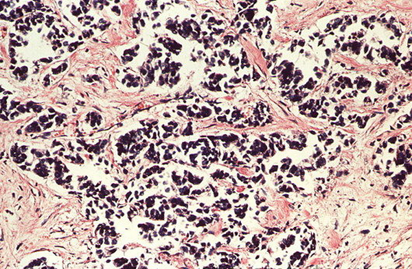 m1320538-lm_of_a_carcinoma_of_the_pancreas-spl.png