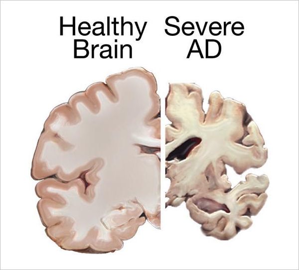 alzheimers_brain.jpg