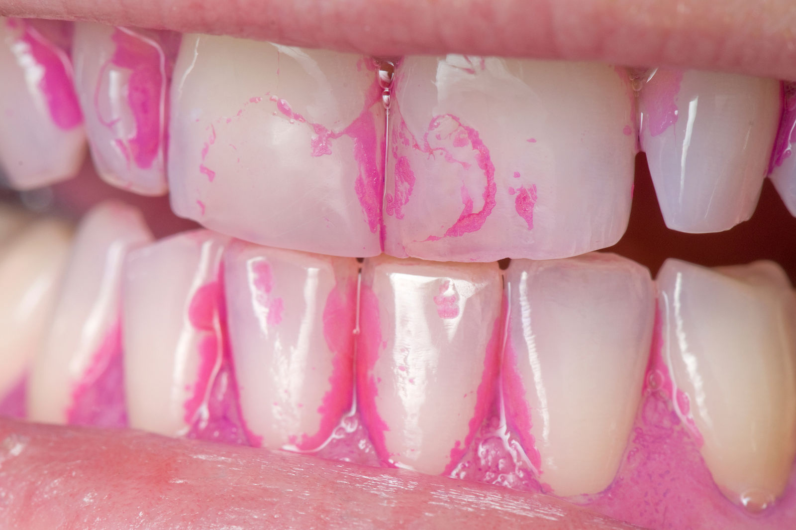 Гигиена полости рта. Метод первичной профилактики стоматологических заболеваний