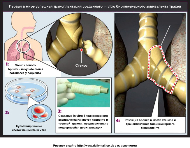 scheme_frst_transplantation_of_trachea.png