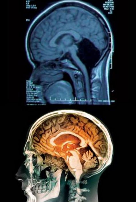 cervello-mancante-474x700.jpg