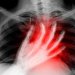 Борьба с последствиями инфаркта, основанная на перепрограммировании клеток сердца