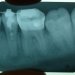 Динамика развития нанопор наноструктурированного пигментированного зубного налета, или Где живет кариес