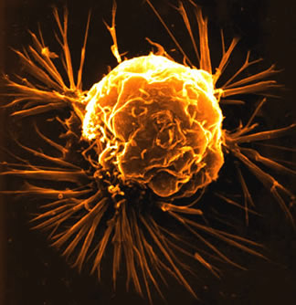 breast_cancer_cell.jpg