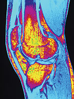 osteoarthritis.jpg