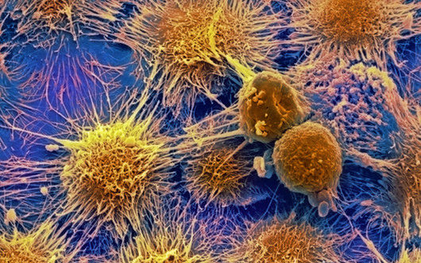 m1320666-kidney_cancer_cells_sem-spl.png