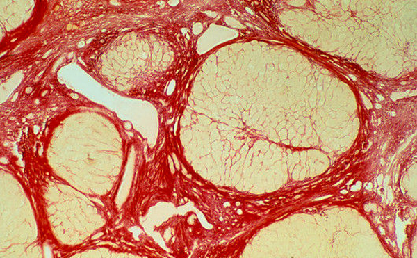 m1300508-lm_of_liver_tissue_showing_cirrhosis-spl.png