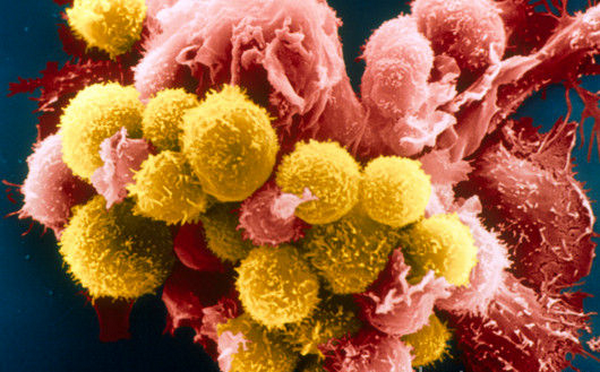 m1320492-coloured_sem_of_lymphocyte_attacking_cancer_cell-spl.png