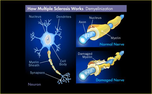 multiple-sclerosis-demyelinization-600.jpg