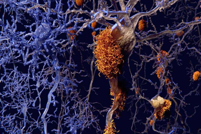 f0117797-brain_nerve_cells_affected_by_alzheimers-spl.jpg