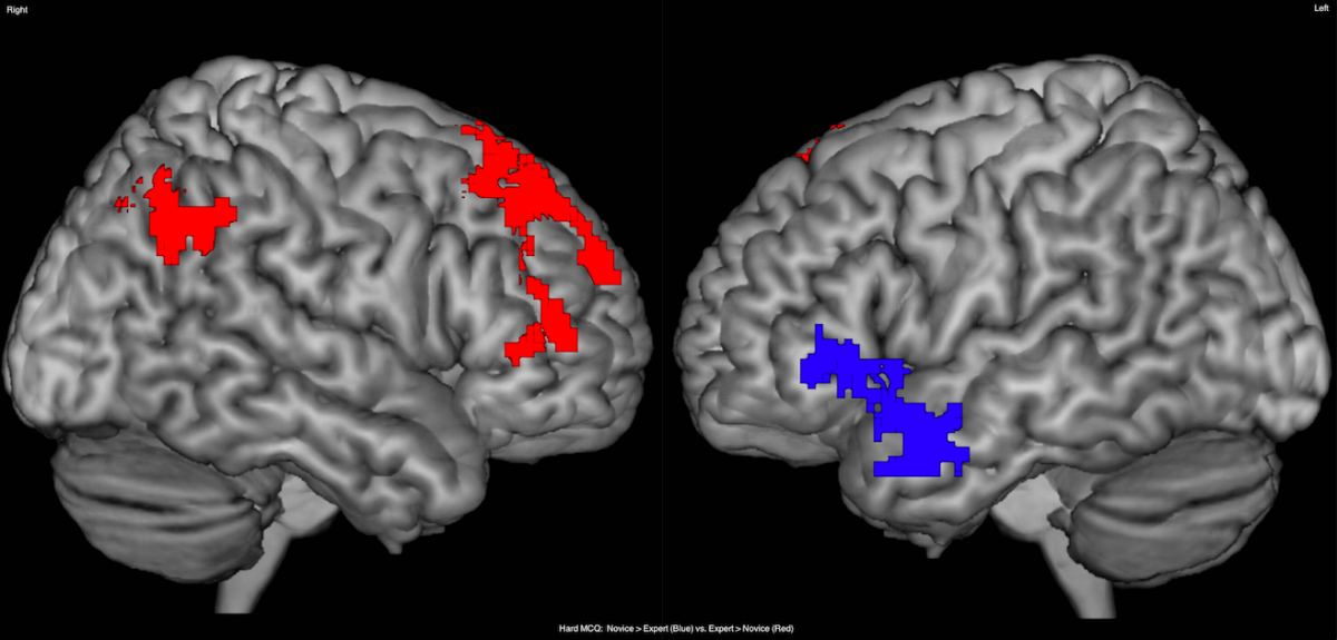 Функциональная магнитно-резонансная томография (ФМРТ). Активность мозга. Возбуждение мозга. ОЭКТ мозга.