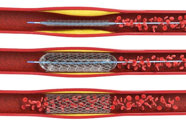 stent1.png
